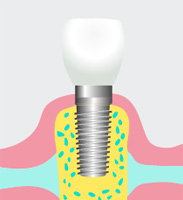 インプラントとは